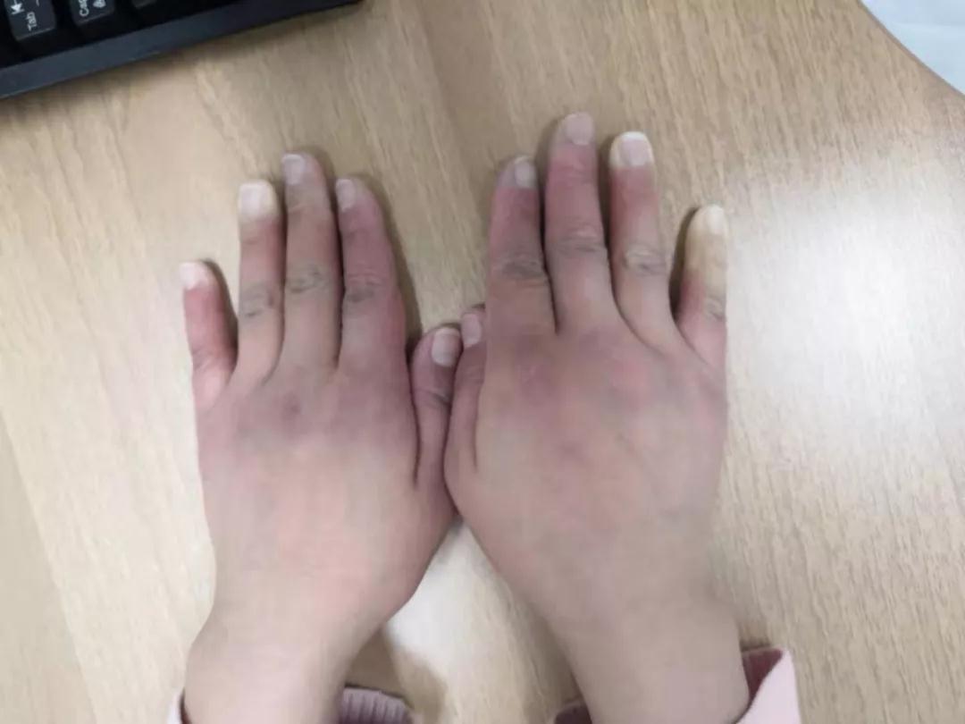“手指、腳趾發(fā)白、發(fā)紫……”這些“小毛病”千萬別大意