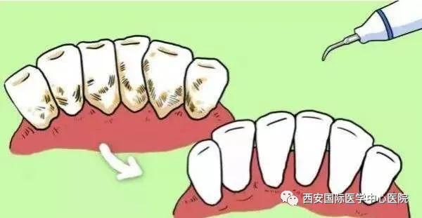 【科普】牙齒上的黃斑好難看，三招告訴你如何預防氟斑牙