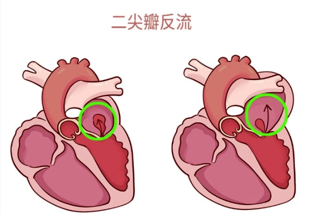 體檢報告里的心臟瓣膜返流，你讀懂了嗎？